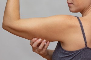 A woman showing arm with sagging skin