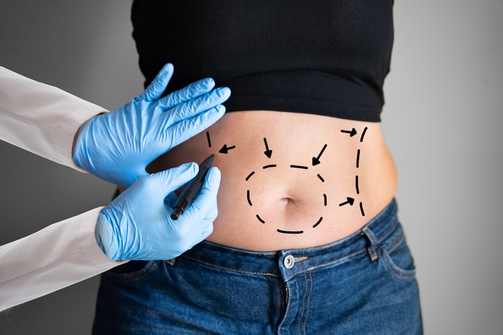 Female patient being evaluated for a tummy tuck