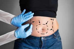 Female patient being evaluated for a tummy tuck
