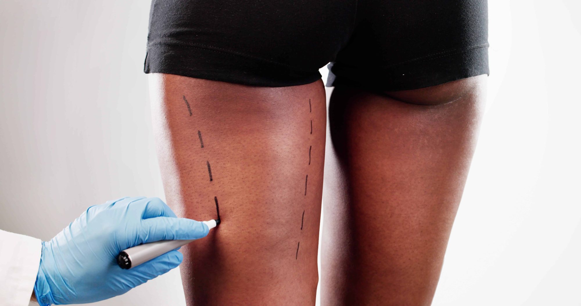 Focused surgeon performing liposuction surgery on thigh of African-American woman in cosmetic clinic setting